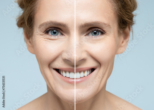 Woman's face before and after skin tightening and anti-aging procedures. Remove of wrinkles, nasolabial folds, skin rejuvenation procedure