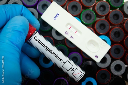Blood sample of patient positive tested for cytomegalovirus by rapid diagnostic test. photo