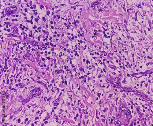 Tissue from axilla (biopsy). Invasive squamous cell carcinoma. Smear show skin, invasive squamous cell carcinoma. Skin cancer.