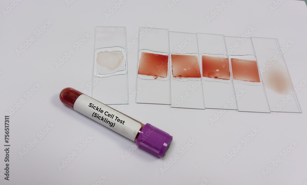Technician preparing blood smear and blood sample for sickling test to