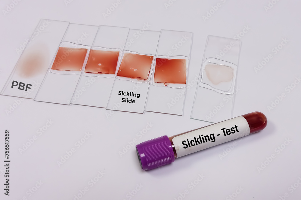 Technician preparing blood smear and blood sample for sickling test to