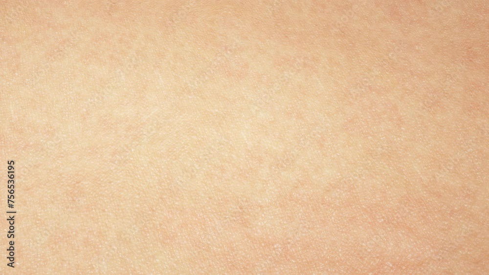 3D Reduce acne Treatment of inflammatory acne and treatment of moderate to severe acne. Serum through the skin layer for removing inflammatory acne. skin acne blemish. 3D Reduce acne Treatment of inflammatory acne and treatment of moderate to severe acne. Serum through the skin layer for removing inflammatory acne. skin acne blemish.
