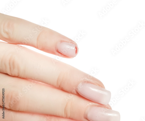 Broken nail on a woman s hand white background. damaged extended nail