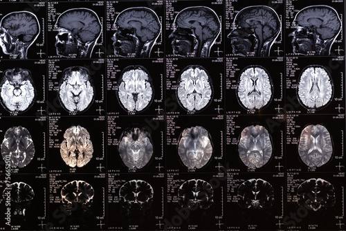 MRI, MRT, CT scan image of human brain. Medical treatmant concept. Diagnosis of the disease humans head. photo