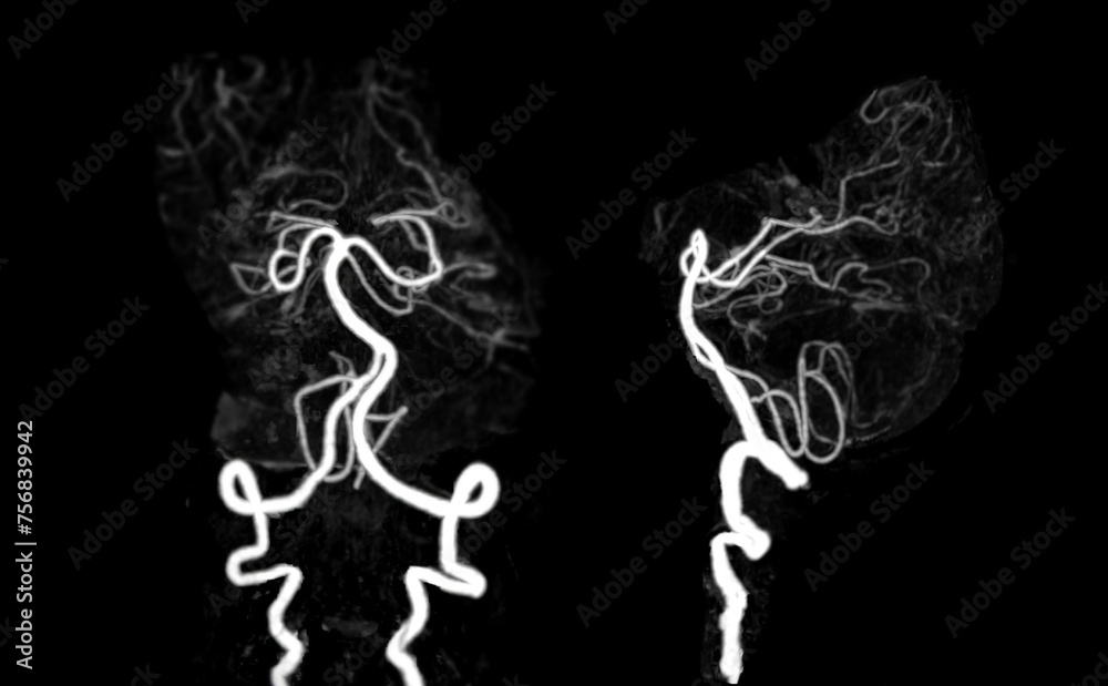 Fototapeta premium CT angiography of the brain or CTA brain showing noraml cerebral artery.
