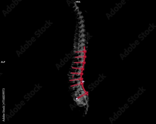  CT scan of thoracic and lumbar spine 3d rendering showing pedicle screw implant after surgical decompression and spinal fusion. photo