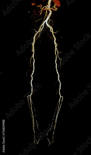 CTA femoral artery run off image of femoral artery for diagnosis  Acute or Chronic Peripheral Arterial Disease. photo