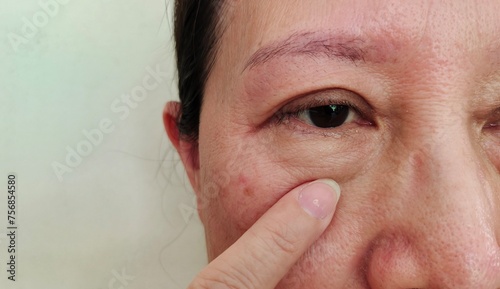 Foto portrait showing the fingers holding the flabbiness and flabby skin, dark spots and blemish on the face, wrinkle and loose beside the eyelid of the woman, health care and beauty concept