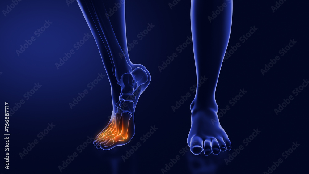 Ball of foot pain or Metatarsalgia