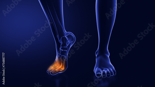 Ball of foot pain or Metatarsalgia photo