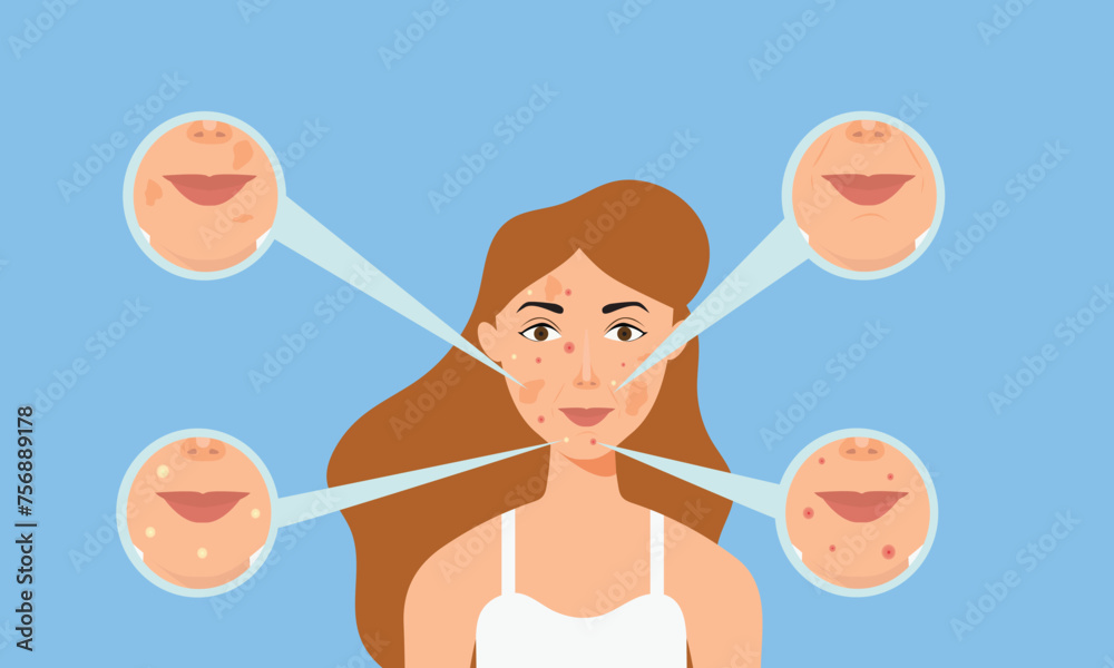 Young girl has skin problems with acne or allergic pimples on her face. Skincare and dermatology concept. Flat style vector illustration. Young girl has skin problems with acne or allergic pimples on her face. Skincare and dermatology concept. Flat style vector illustration.