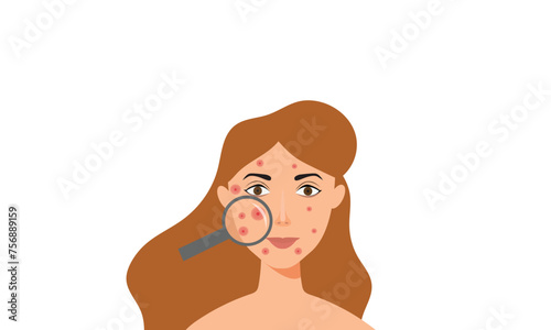 Young girl has skin problems with acne or allergic pimples on her face. Skincare and dermatology concept. Flat style vector illustration.