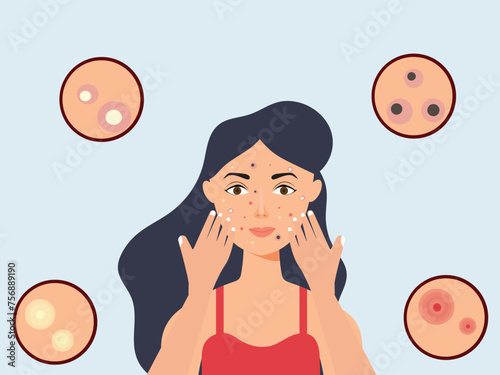 Young girl has skin problems with acne or allergic pimples on her face. Skincare and dermatology concept. Flat style vector illustration.