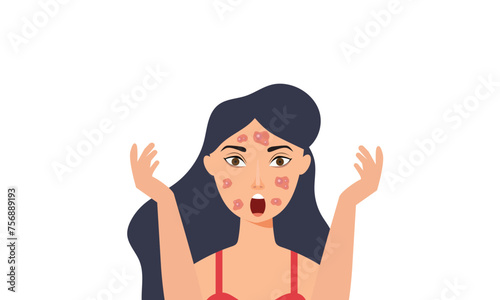 A young girl has skin problems with acne, Vitiligo skin and allergic pimples on her face. Skincare and dermatology concepts. Flat style vector illustration.