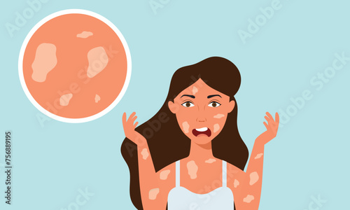 A young girl has skin problems with acne, Vitiligo skin and allergic pimples on her face. Skincare and dermatology concepts. Flat style vector illustration.
