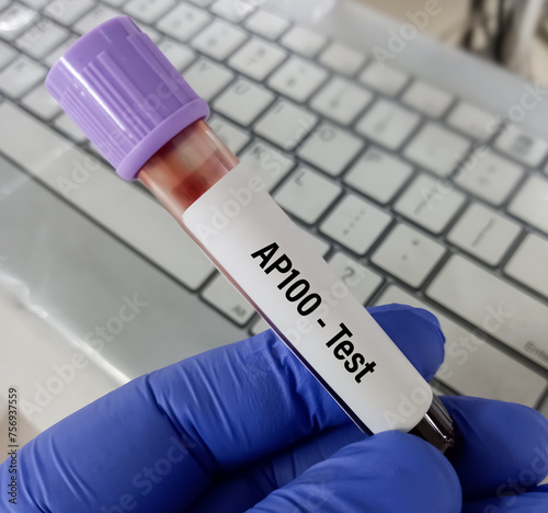 Blood sample for AP100 test, total hemolytic complement. to measurement of complement haemolytic activity. photo