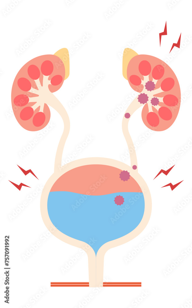 腎盂腎炎の医療イラスト、細菌が膀胱から腎臓に逆流する流れ