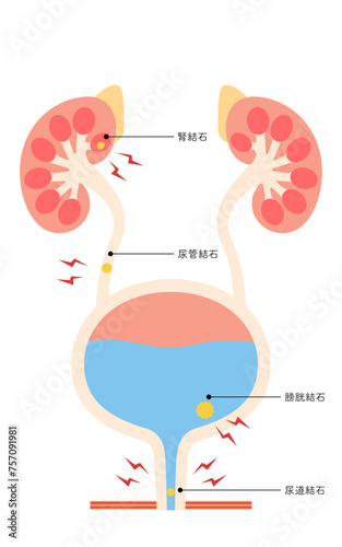 尿路結石の医療イラスト、腎結石・尿管結石・膀胱結石・尿道結石