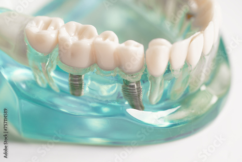 Dental implant, artificial tooth roots into jaw, root canal of dental treatment, gum disease, teeth model for dentist studying about dentistry. photo