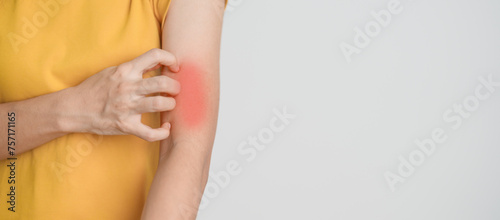 woman itching and scratching itchy arm. Sensitive Skin Allergic reaction to insect bite  food  drug dermatitis. Dermatology  Leprosy day  Systemic lupus erythematosus  Allergy symptoms and rash Eczema