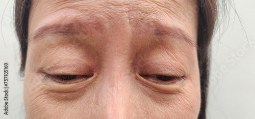 close up the wrinkle and Flabby skin, sadness and worried, freckles and blemish on the face of the woman, health care and beauty concept.