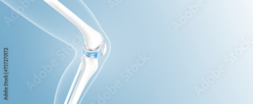 Total knee replacement or implant for treatment relieve arthritis, after joint damaged. Leg bone and cartilage side with copy space for text. Medical health care science technology concept. 3D vector.