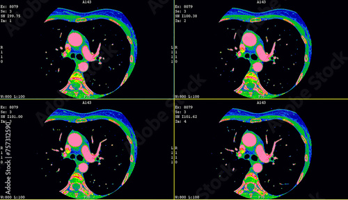 Axial contrast of the cardio system with radiology. CT Coronary angiography photo