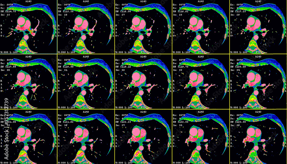 Axial images showing a thymic carcinoma CT cardiac scan. Computer
