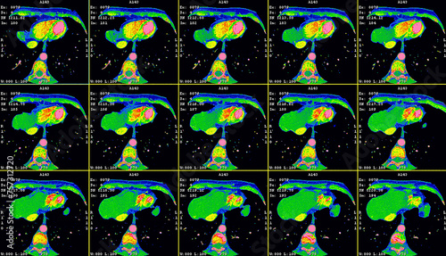 Angio CT cardiac scan. Computer tomography image of the heart photo