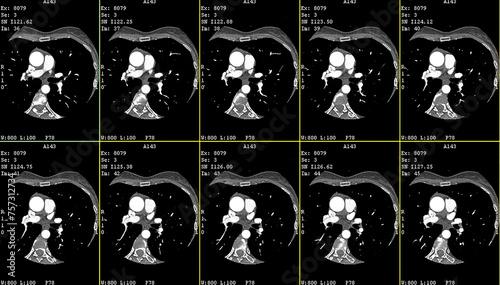  A computerized tomography CT coronary angiogram. Axial contrast of the cardio system with radiology