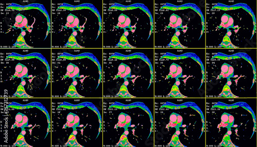 Axial images showing a thymic carcinoma CT cardiac scan. Computer tomography image of the heart photo