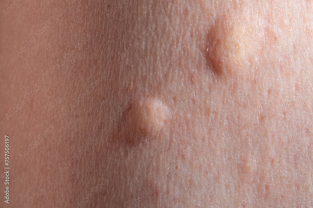 detailed macro shot of human skin with mosquito bite detailed macro shot of human skin with mosquito bite