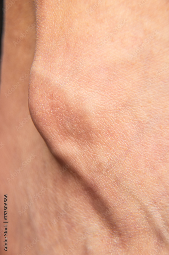 Close-Up of a Protruding Bone Spur on Human Skin Close-Up of a Protruding Bone Spur on Human Skin