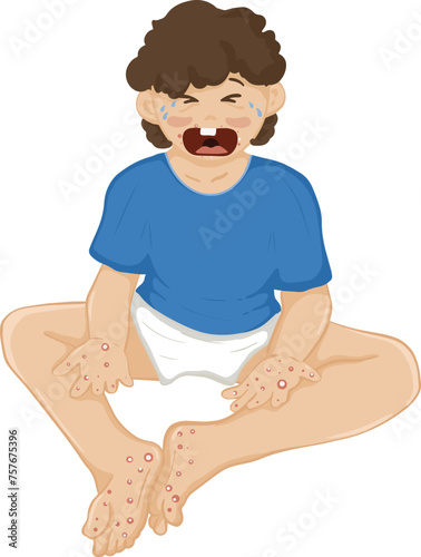 Cartoon HFMD children infected. hand foot and mouth disease. Enterovirus 71 (EV71) Coxasackie Virus. vector illustration.