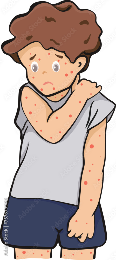 Vector flat character illustration. Looking rash of children which has symptoms of smallpox chickenpox.disease diagnose.red rash Vector flat character illustration. Looking rash of children which has symptoms of smallpox chickenpox.disease diagnose.red rash