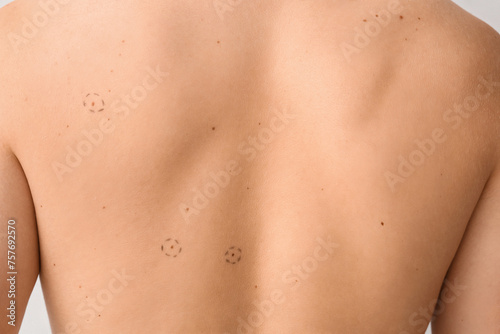 Young man with moles on light background, back view