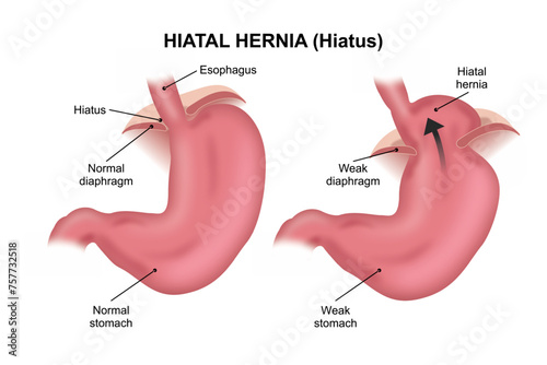 Hiatal hernia (hiatus) 3D illustration