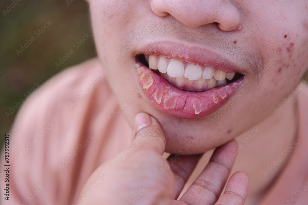 Stomatitis in lips are caused by the excretion of heat from the inside of the body and Inflammation, Mouth ulcers of a young Asian man,Drink water, get enough rest and consult a doctor for treatment. Stomatitis in lips are caused by the excretion of heat from the inside of the body and Inflammation, Mouth ulcers of a young Asian man,Drink water, get enough rest and consult a doctor for treatment.