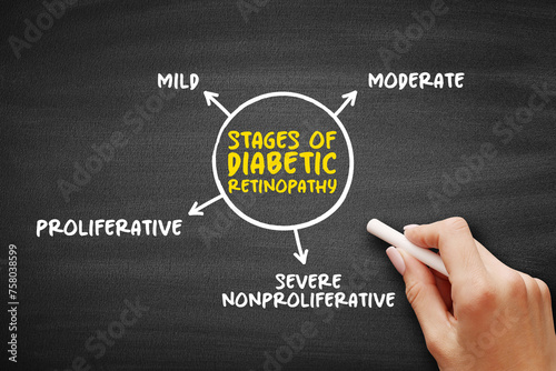Stages of diabetic retinopathy (diabetes complication that affects eyes) mind map concept background photo