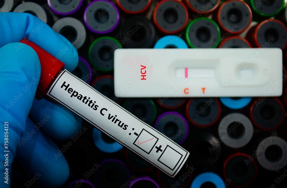 Obraz premium Blood sample of patient negative tested for hepatitis B virus by rapid diagnostic test.
