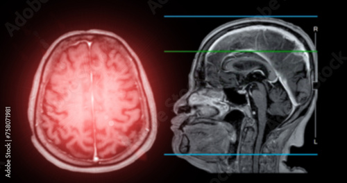MRI brain scan sagittal plane for detect Brain diseases sush as stroke disease, Brain tumors and Infections.