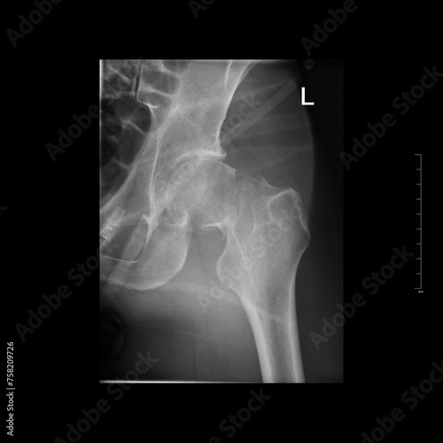 Left transcervical neck fracture. Femoral neck fracture. Joint closeup. X-ray photo of man. Roentgenogram. One day after fracture