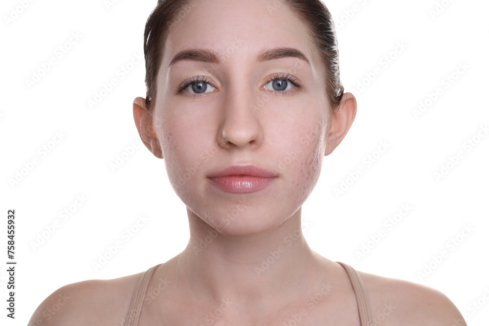 Young woman with acne problem on white background Young woman with acne problem on white background