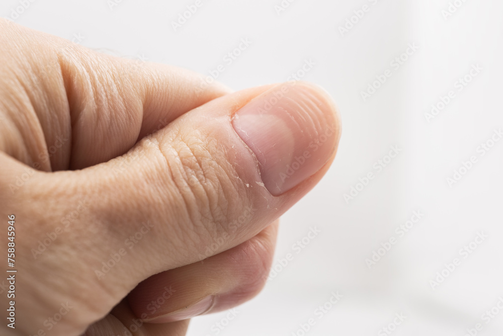 Ridged fingernail of a thumb finger of a man with horizontal ridges on white background. Ridged fingernail of a thumb finger of a man with horizontal ridges on white background.