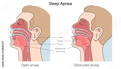 Sleep apnea structure diagram hand drawn schematic vector illustration. Medical science educational illustration