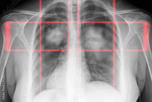 Billede på lærred X-ray of human cancer lungs