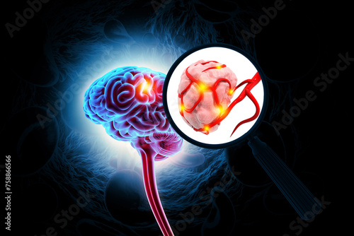 Brain tumor or barin cancer. 3d illustration photo