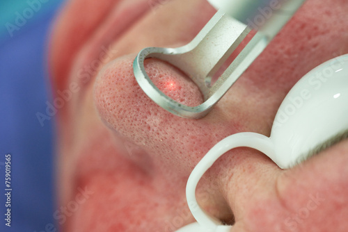 Obraz na płótnie Laseroterapia w medycynie. Odmładzanie, regeneracja skóry, usuwanie blizn. w salonie