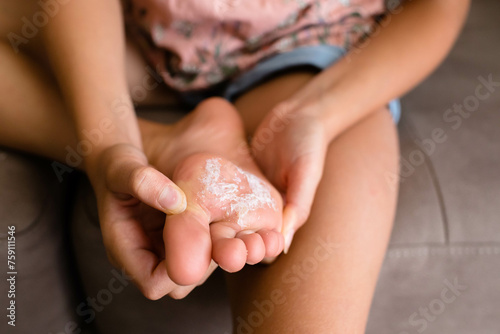 Plantar warts covered with white salve 
