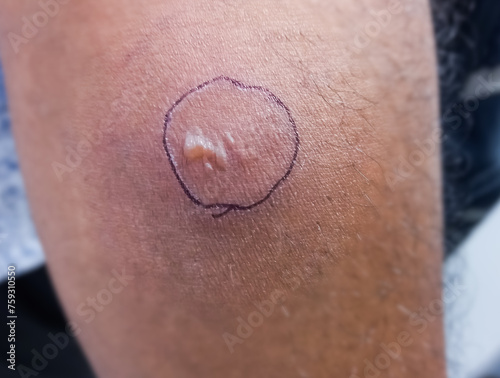 Tuberculin test. Mantoux vaccination, Closeup view photography of patient arm with red spot reaction to conducting Mantoux test. Positive tuberculosis patient. photo